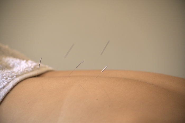 acupuncture needles inserted in lower back